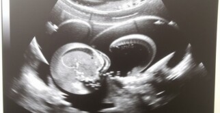 Рак яичника на УЗИ: диагностика и эффективное лечение